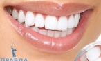 Для чего нужны виниры на зубы?