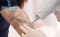 Лазеры для удаления тату: что нужно знать об особенностях