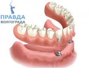 Покрывные протезы